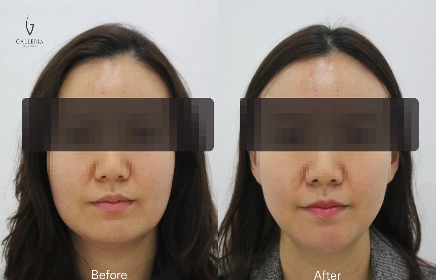 Anonymized Korean plastic surgery before and after facial balance case