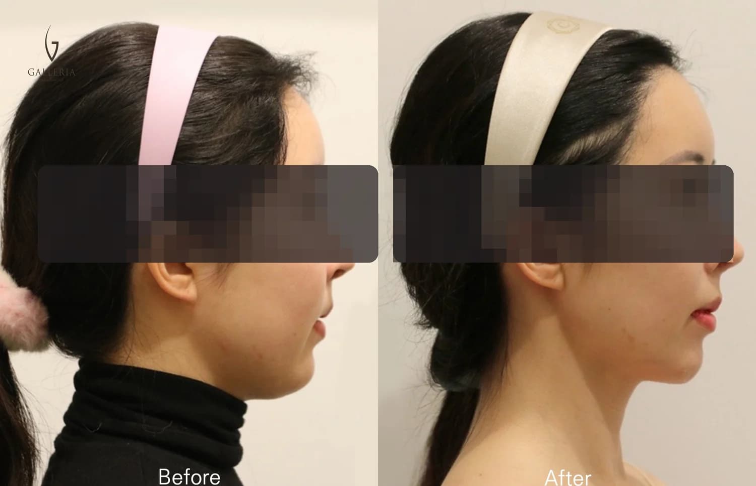Anonymized Korean plastic surgery before and after side profile case