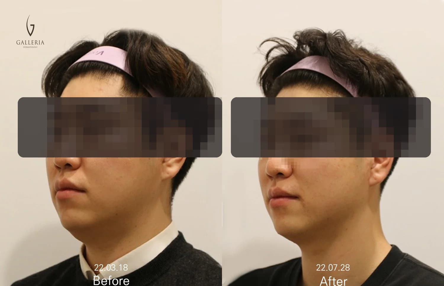 Anonymized male facial contour before and after case in Korea