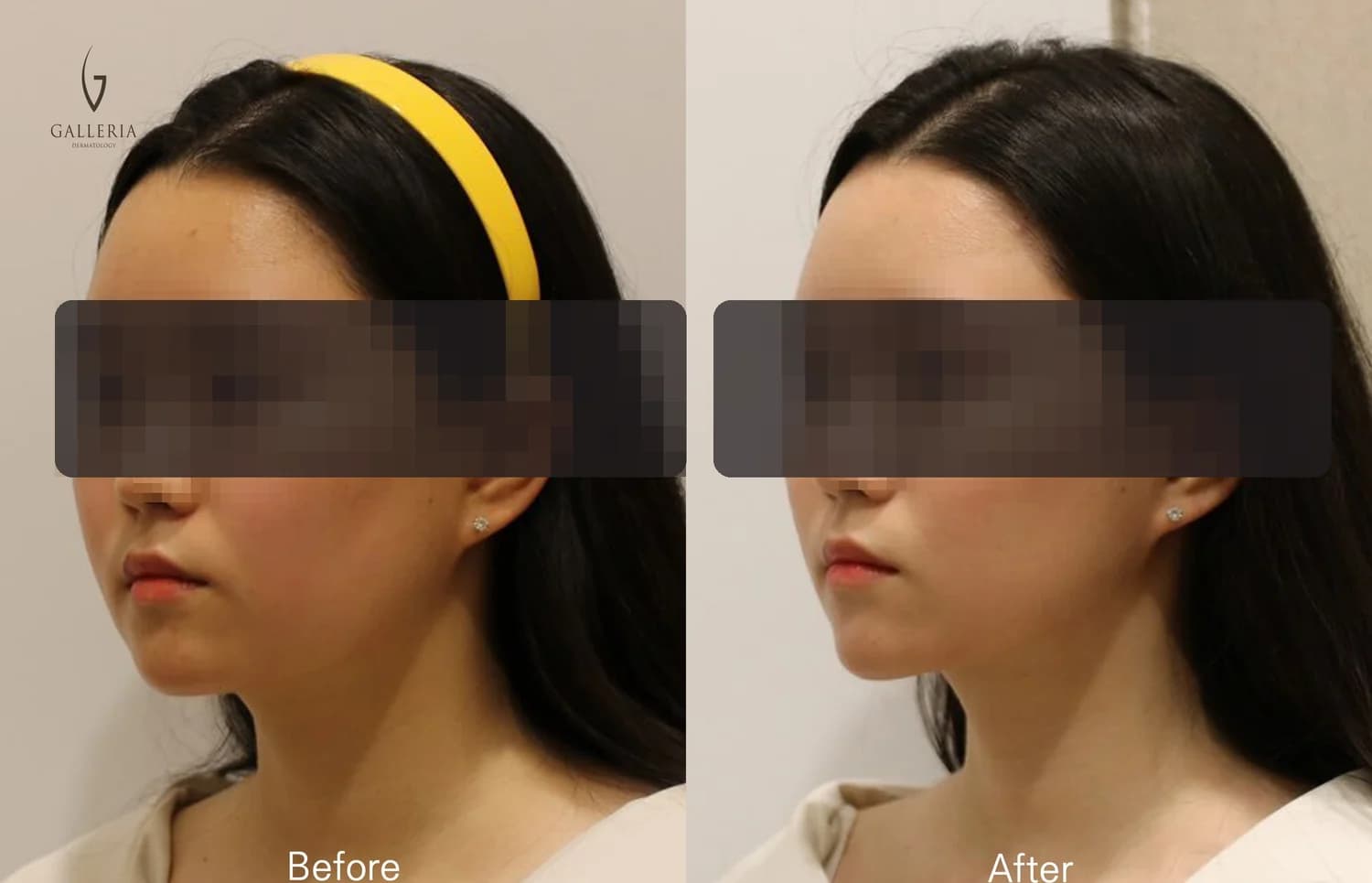 Anonymized facial contour before and after case in Korea
