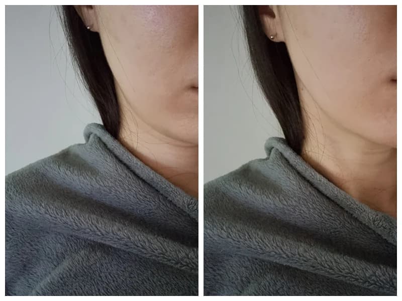 Anonymized lower face before and after jawline case