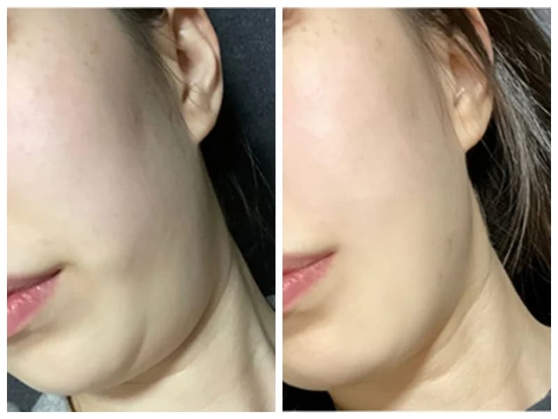 Anonymized lower cheek and jawline before and after case